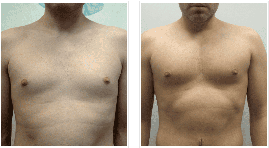 Pectoral Implants before and after photos Chicago, IL