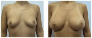 breast augmentation chicago