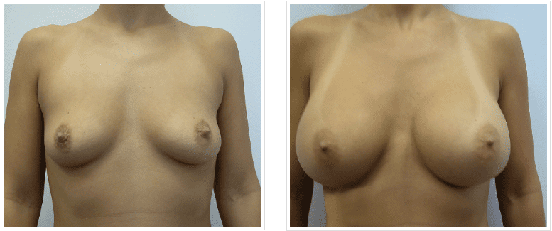 breast augmentation before and after photos chicago, il