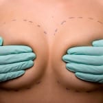 breast augmentation chicago