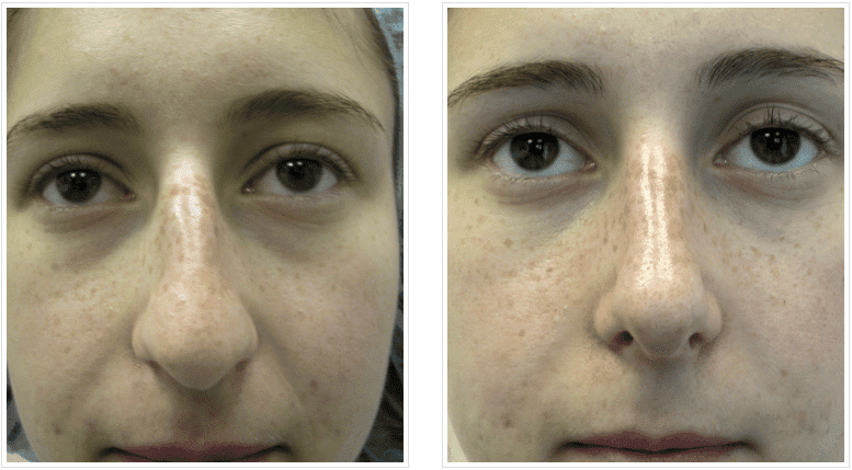 rhinoplasty before and after photos chicago, IL