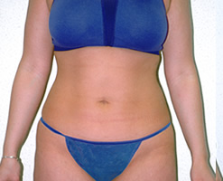 After Image: Patient # 50416 - 