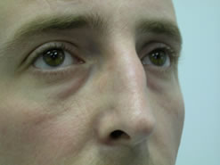 Before Image: Patient # 79878 - 