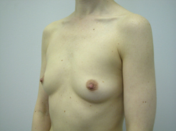 Before Image: Patient # 13531 - 