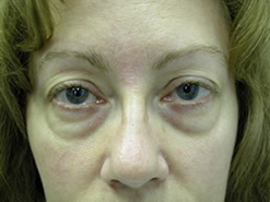 Before Image: Patient # 39324 - 