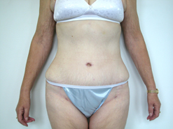 After Image: Patient # 45693 - 