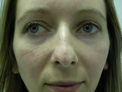 Before Image: Patient # 23611 - 