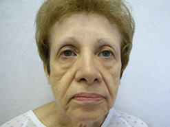 Before Image: Patient # 46636 - 