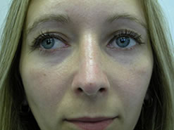After Image: Patient # 23611 - 