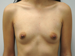 Before Image: Patient # 99298 - 