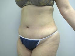 After Image: Patient # 46579 - 