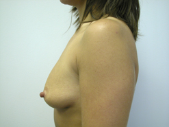 Before Image: Patient # 42342 - 