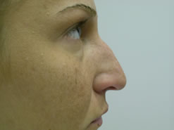 Before Image: Patient # 49021 - 