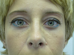 After Image: Patient # 57571 - 