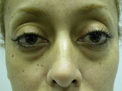Before Image: Patient # 72282 - 