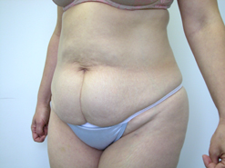 Before Image: Patient # 46579 - 