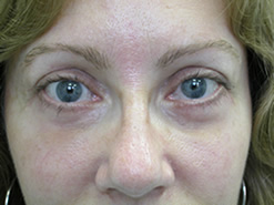 After Image: Patient # 39324 - 