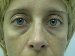 Before Image: Patient # 57571 - 