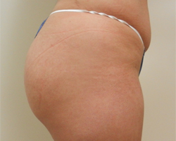 After Image: Patient # 41287 - 