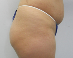Before Image: Patient # 41287 - 