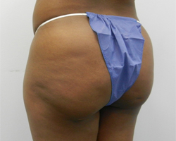 Before Image: Patient # 42604 - 