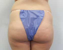 Before Image: Patient # 21691 - 