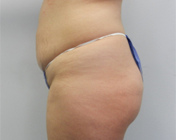 Before Image: Patient # 21691 - 