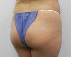 Before Image: Patient # 41287 - 