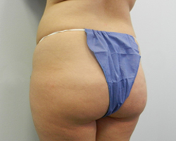 Before Image: Patient # 21691 - 