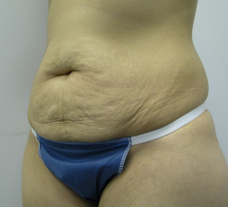 Before Image: Patient # 29744 - 