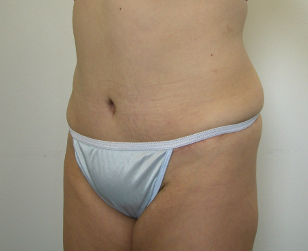 After Image: Patient # 14787 - 