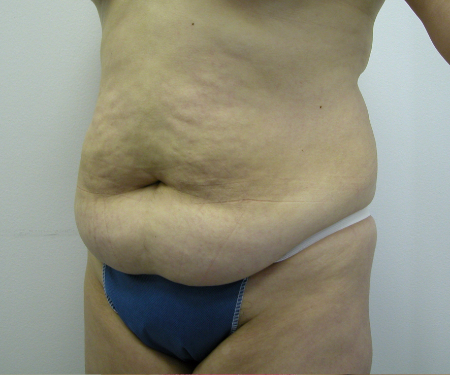 Before Image: Patient # 14787 - 