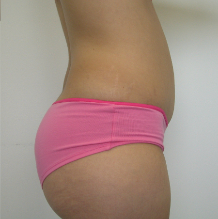 After Image: Patient # 29744 - 