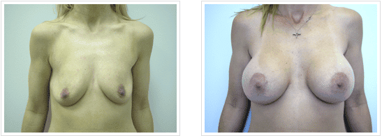 breast augmentation with Breast Lift before and after photos Chicago, IL
