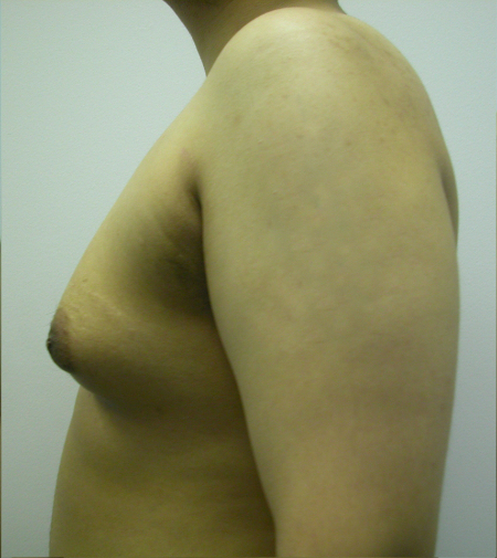 Before Image: Patient # 39379 - 