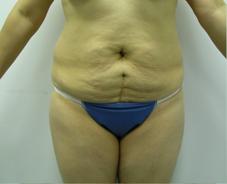 Before Image: Patient # 87805 - 