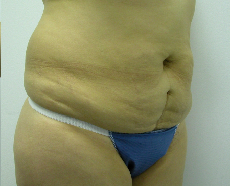 Before Image: Patient # 87805 - 