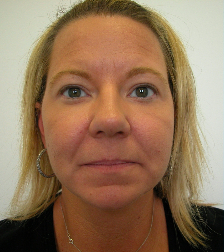 After Image: Patient # 50164 - 