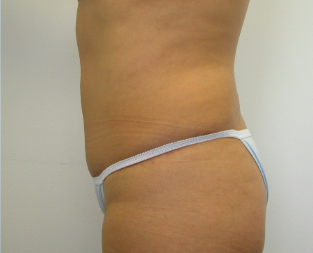 After Image: Patient # 87805 - 