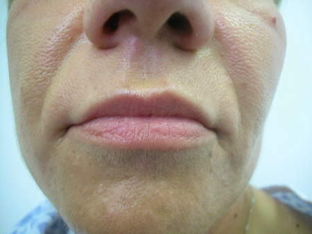 After Image: Patient # 97248 - 