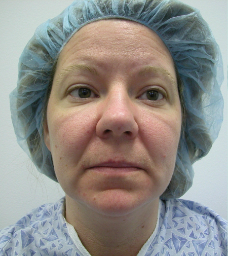 Before Image: Patient # 50164 - 