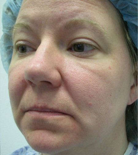 Before Image: Patient # 50164 - 