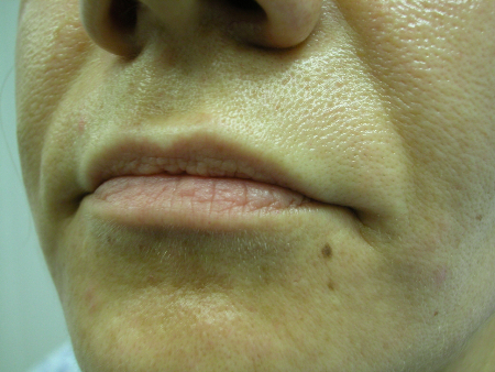 Before Image: Patient # 97248 - 