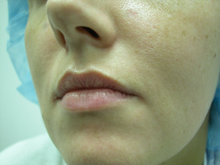 Before Image: Patient # 86112 - 