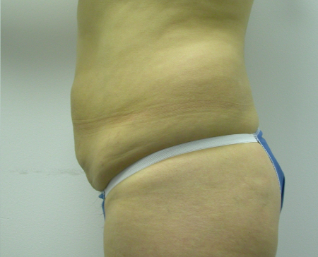 Before Image: Patient # 87805 - 