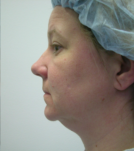 Before Image: Patient # 50164 - 