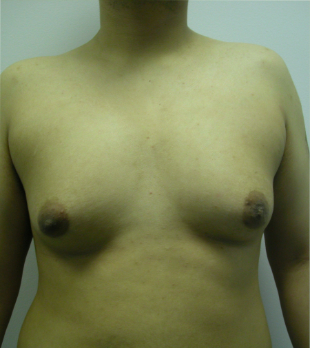 Before Image: Patient # 39379 - 