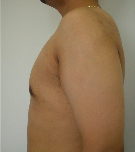 After Image: Patient # 39379 - 