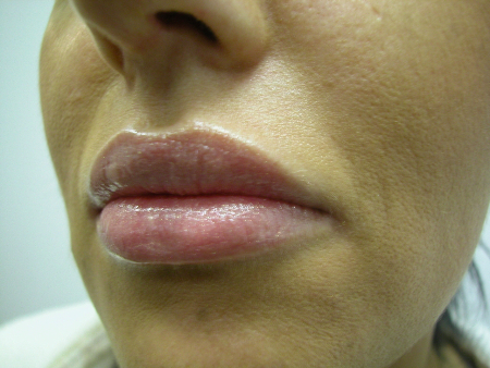After Image: Patient # 86112 - 