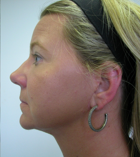 After Image: Patient # 50164 - 